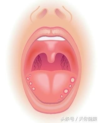 健康天天测,舌头发炎后该怎么办?