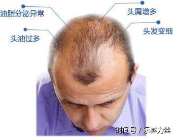最新科研:根治脂溢性脱发的好方法!