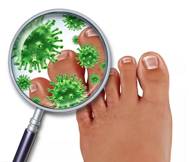 脚气,真菌感染是缺乏维生素B1?