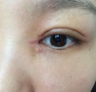 整形医院开眼角