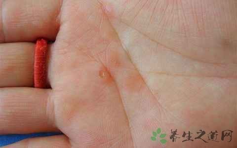 梅毒抗体阳性可以母乳吗