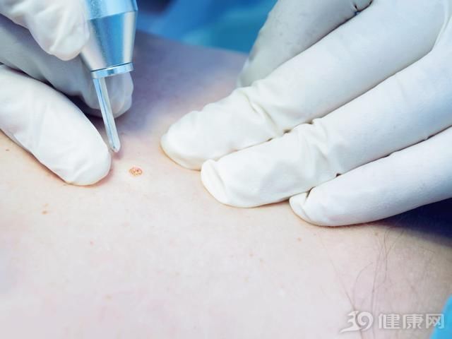 身上的痣,该如何去掉?3个方法,各有所长