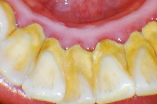 牙齿上的黄泥是什么?如何才能去除?