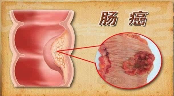 肠胃科专家：腹胀不可大意，易诱发肠癌，这4类人群，一定要注意