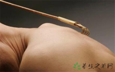 神经性皮炎能自愈吗