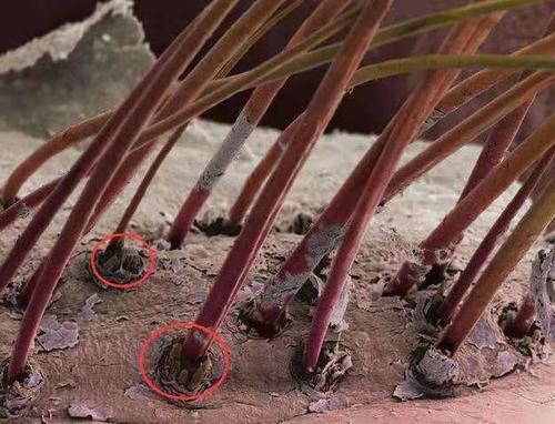 脱发、头发油、头皮屑多可能是螨虫在作怪,用