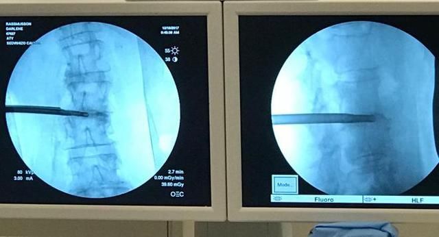 腰椎间盘突出手术费用
