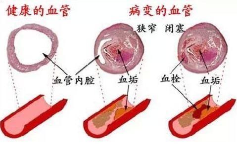 饭后三个小动作，血管一辈子不怕堵!