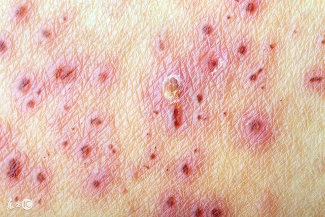 丘疹状荨麻疹有哪些常见的典型症状