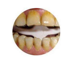 牙齿上黄黄的臭臭的东西是什么呢?如果还在增