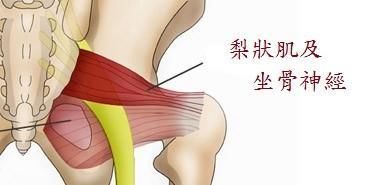 放射性臀部疼痛伴下肢，不是腰椎间盘突出却是因为它