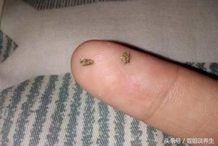 牙齿缝里,抠出的黄色物质是什么?为啥还那么