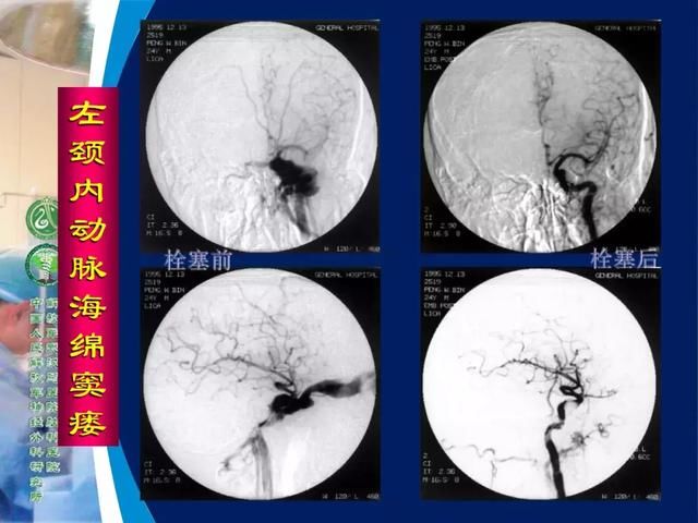 39年前开创“复合手术”，治愈颅底高位颈内动静脉瘘