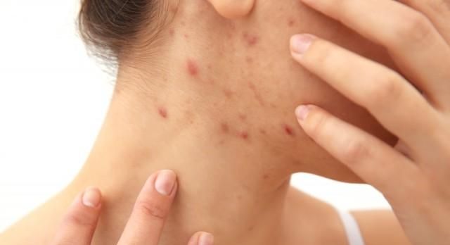 怎样除掉面部螨虫,教你除螨虫最好的方法