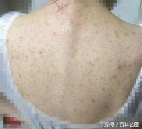 脖子上、背上大片起痘痘是怎么了？怎样消除？