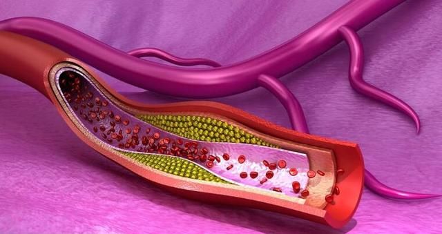 血脂是血管的定时炸弹！此物每天3克，血管干干净净，血脂全溶光