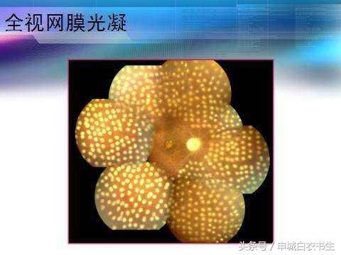 那么,雷珠单抗可以用于治疗糖尿病视网膜病变