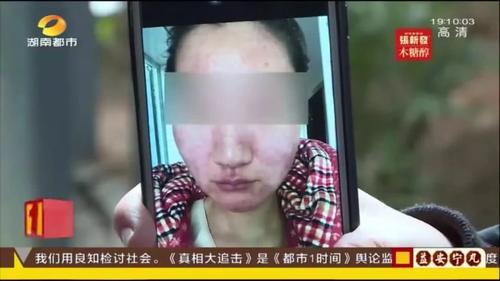 长沙一女子祛痘两天后脸部红肿、瘙痒 痘痘变