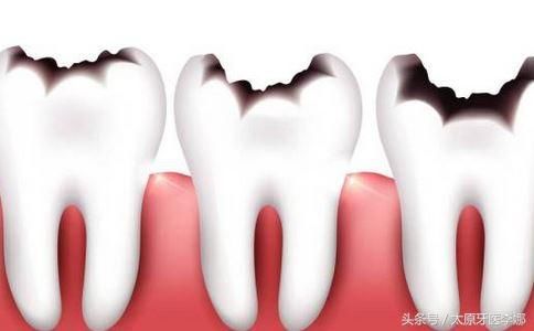 牙齿龋坏，补牙疼吗?