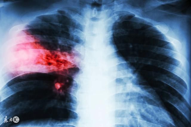 什么是大叶性肺炎,胸透可以清晰看到大叶肺部