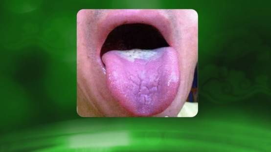 专家教您从舌苔辨体质,从舌苔断病症,从舌苔看