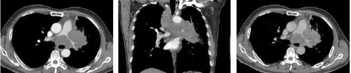 肺CT也会装酷:如何从CT上看出肺癌的病理类型?