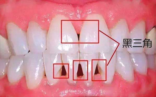 在牙齿正畸过程中,应该注意哪些事情?