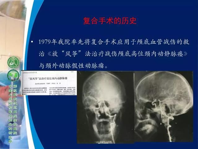 39年前开创“复合手术”，治愈颅底高位颈内动静脉瘘