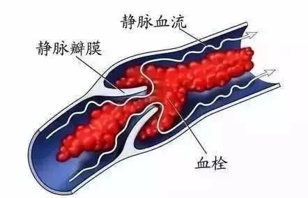 美高梅注册:腿部出现这种现象,分分钟危及性命 美高梅注册:腿部出现这种现象,分分钟危及性命