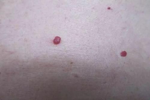 身上这些像小红痣的小点,还不痛不痒的,是怎
