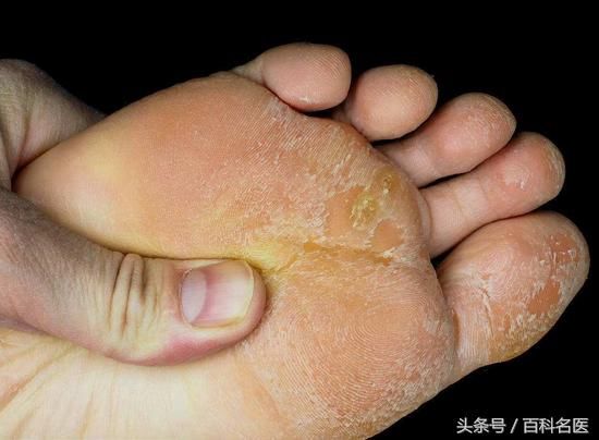 脚后跟干裂脱皮是怎么回事儿?送你几个嫩足小妙方!