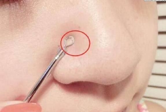 鼻子上挤出来的小白点是黑头还是螨虫?这样