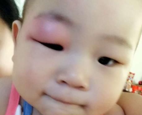 招蚊子的宝宝,皮肤上一定要抹点它!快速止痒消