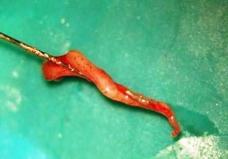 牙神经不能随便杀?医生说出了真相