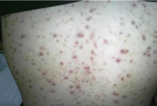 背上长了很多小米粒,挤出来里面一个硬硬的,