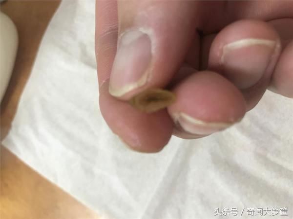 网友拉屎拉出17颗宝石以为发财！眼尖网友：不要碰，快看医生