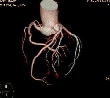 冠脉CTA和冠脉造影哪个检查更好?