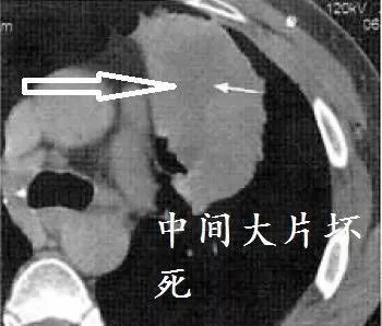 肺CT也会装酷:如何从CT上看出肺癌的病理类型?