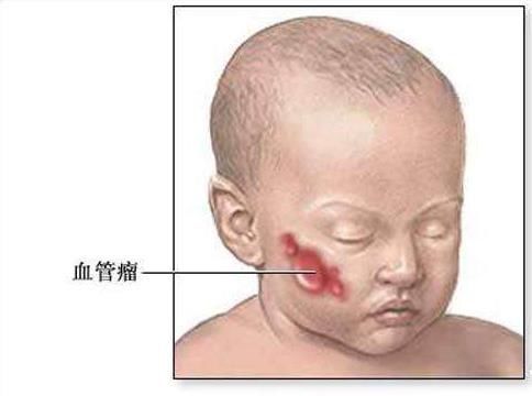 小儿血管瘤:宝宝身上现红痣 警惕小红痣变小