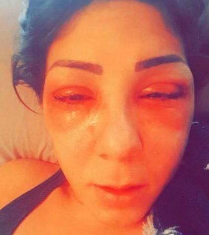 25岁女子整容失败,导致眼睛无法睁开,差点变成