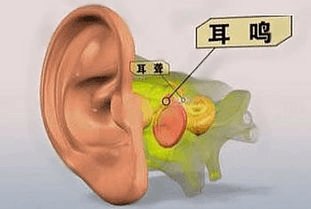 治疗耳鸣 中医方法多,学习下