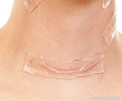 美女打耳洞后居然长出一个“新耳朵” 全因这种特殊体质