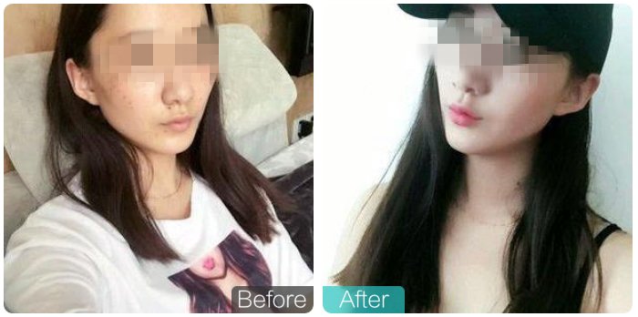 吉米祛斑真实案例 想变美一定要看!