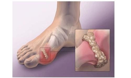 痛风最怕血尿酸这个指标高,常喝这种茶可降低