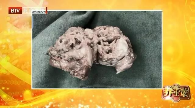 它是一种能摸到的恶性肿瘤,用手摸一摸,自检这种“危险分子”!