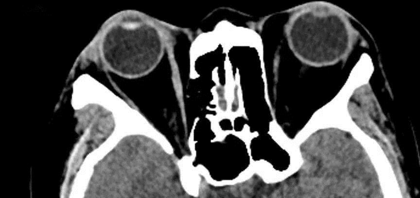 腹痛腹泻,竟是脑病引发的,来看下MRI图像确诊