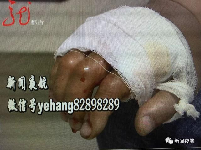 有毒!男子上山挖野菜被“土球子”袭击,紧急救治!医生说:切不