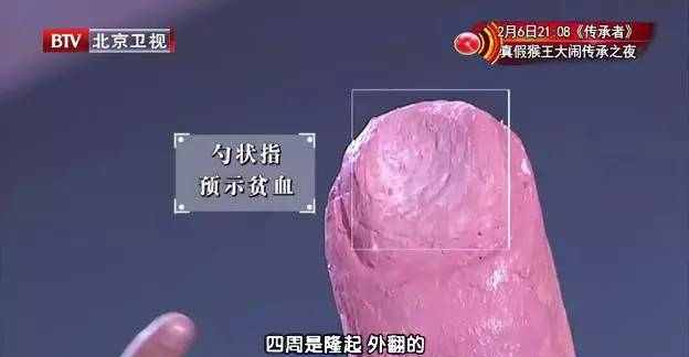 夫妻同时患上胃癌 谨防餐桌上的夫妻癌