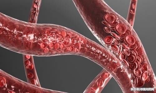 通过输液扩张血管对高血压有效吗?如何预防血管堵塞?