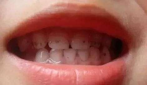 门牙缝发黑蛀牙的图片